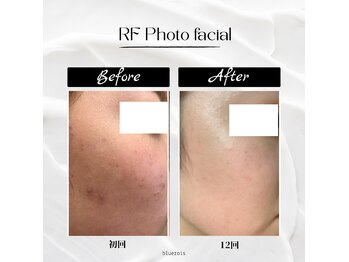 ブルーロワーズ(bluerois)