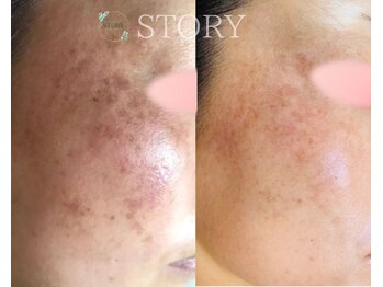 ストーリー(STORY)/ハーブピーリング専門店STORY