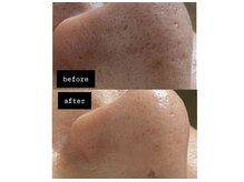 ニコラフ(Nico laugh)/毛穴洗浄