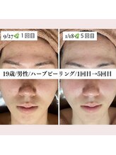 ホワイトアクア 福岡天神店(WHITE AQUA)/10代男性/ハーブピーリング