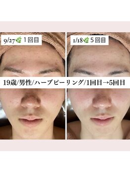 ホワイトアクア 福岡天神店(WHITE AQUA)/10代男性/ハーブピーリング