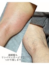 ノーマコルポ(noma corpo)/静脈瘤も改善