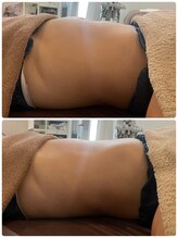 ミニマル(minimal)/むくみスッキリ！HOT腸もみ