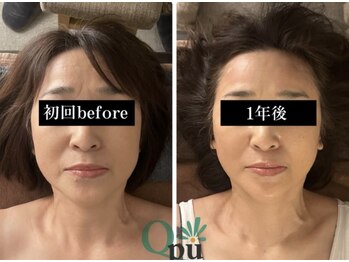 キュープ 鹿児島伊集院店(Qpu)/1年でここまで変わります！