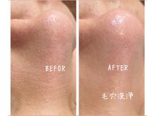 メンズプシュケ(men's PSYCHE)/毛穴洗浄