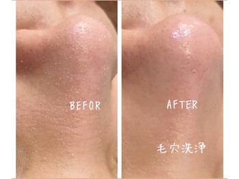 メンズプシュケ(men's PSYCHE)/毛穴洗浄