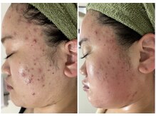 リクラ 北千住(Reclat)/ハーブピーリングオーダーメイド