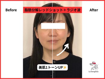 ラ セラフィータ 中目黒/レモンボトル＋ラジオ波