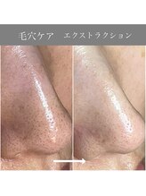 カミーシャ(KaMi-Sha)/【40代女性】毛穴症例写真