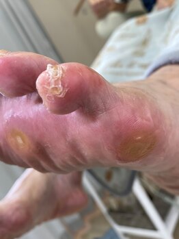 フットメンテ 巻き爪矯正センター 南浦和/魚の目　