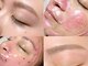 エトレ(ETOLE)の写真/【毛穴レスWAX】眉を整え顔全体のWAX◎産毛、角質を除去！ざらつきをケアし艶肌へ♪