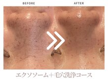 エステティックサロン ラ ベルタ(Esthetic Salon La Belta)/エクソソームコース（1回）