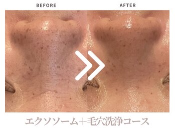 エステティックサロン ラ ベルタ(Esthetic Salon La Belta)/エクソソームコース（1回）