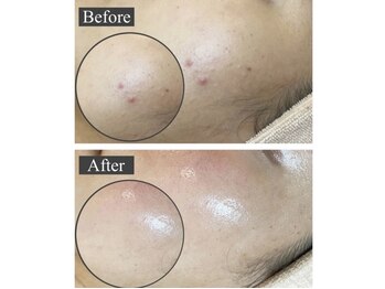 リリー 岐阜店(Lily)/プラズマ×ハーブピーリング