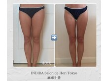 インディバホリトウキョウ(INDIBA HORI TOKYO)/美脚も叶います