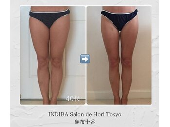 インディバホリトウキョウ(INDIBA HORI TOKYO)/美脚も叶います