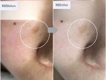 ティーツリー 名古屋 桜山(Tea Tree)/Tea Treeのシミケアはすごいです