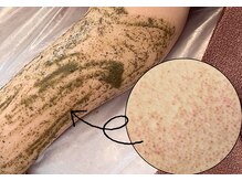 ベレミアム(Bellemium)/二の腕のサメ肌、赤み