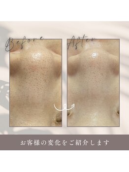 ルルーディア(LOULOUDIA)/毛穴ケア洗浄で美肌づくり