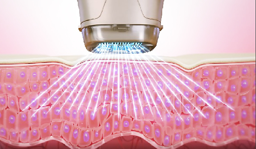 最新プラズマケア + 高周波500shot ¥8000円