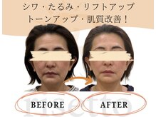 リセット鍼灸院(Risetto鍼灸院)/しわ・たるみ改善！