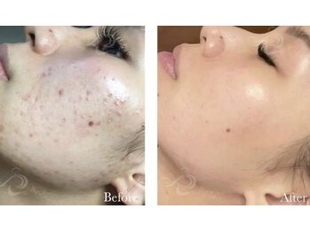 シックスティーエイトフェスター(68FESTAR★)/こんなに変わる!写真は6回の施術