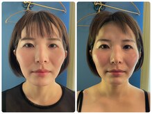 クランシュプール恵比寿鍼灸院/ビフォーアフター/1回の変化！