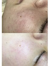 イベリス(Iberis)/フェイシャルワックス/水光肌