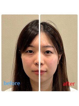 ルマオーナ(LUMAONA)/筋膜リリース（顔）＋美容針