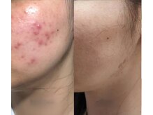 シューン(schon)の雰囲気（気軽に肌管理☆ブツブツ肌にお悩みなら断然ハーブピーリング！）