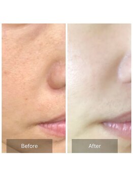 エミルカ 岡山店(EMILUCA)/お顔の施術事例