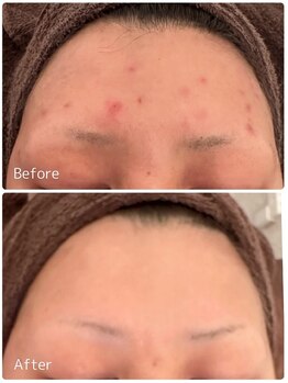 ククル(KUKULU)/ハーブ3回目♪ (40代女性)