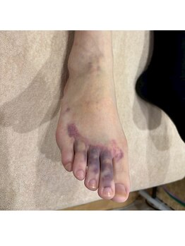 グレフル鍼灸接骨院 整体院 心斎橋/整体/肩こり/マッサージ/腰痛