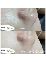 ベルクラージュ(Belle Courage)/20代　毛穴の黒ずみ