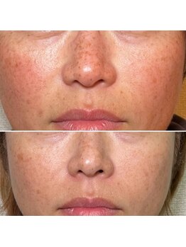 Mirai【毛穴/ハーブピーリング/エイジングケア/頭皮ケア】【3/1 NEW OPEN (予定)】/お悩み一気に改善！