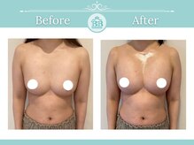 美人バスト 赤羽店/【バストアップ★育乳】症例