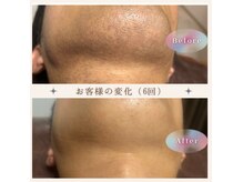 オフ(off)の雰囲気（アゴ下脱毛6回！かなり変化が見えてきました♪）