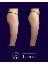 小顔・脂肪コントロール専門 salon de nurse U.sona～松本店～/【痩身】太もも脂肪分解症例