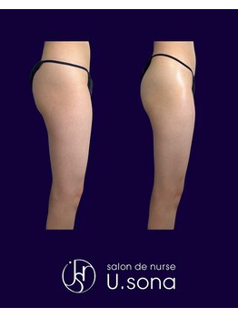 小顔・脂肪コントロール専門 salon de nurse U.sona～松本店～/【痩身】太もも脂肪分解症例