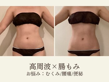 ミオン(美温)/高周波×腸もみ