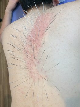 ワイズ 宜野湾鍼灸整骨院/鍼　　背中