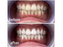 エクシアホワイト 立川南口店/セルフホワイトニング