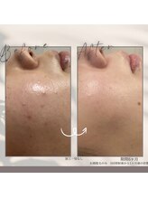 モアトゥインクル 山口店(MORE twinkle)/★症例写真★【20代】