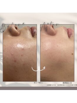 モアトゥインクル 山口店(MORE twinkle)/★症例写真★【20代】