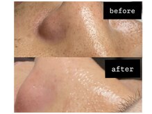 ニコラフ(Nico laugh)/顔WAX脱毛　産毛