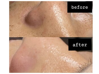 ニコラフ(Nico laugh)/顔WAX脱毛　産毛