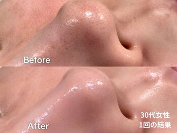 フェイシャルサロンBenny/ダブル毛穴洗浄1回|30代女性