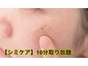8月限定【シミとり】お顔シミとり　¥990