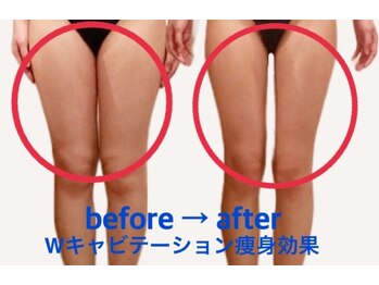 アーデン(ARDEN)/劇的最強痩身Wキャビテーション