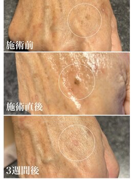 ヴィアージュ(Viage)/シミケア